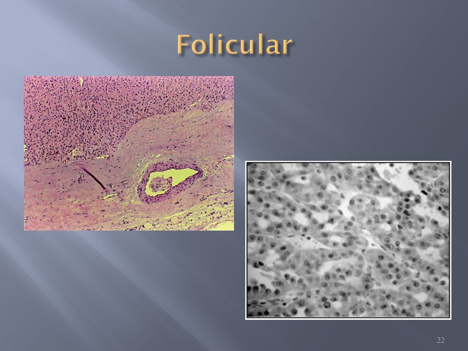 Folicular Mayor invasión y metástasis localmente. Tienden a recurrir después de cirugía.