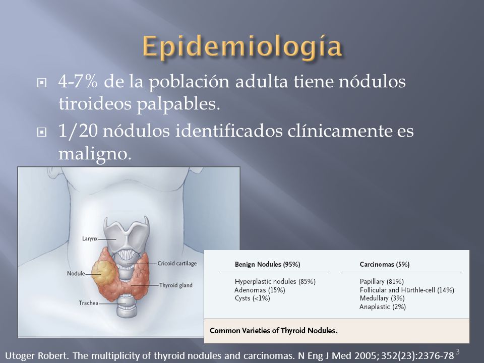 Epidemiología 4-7% de la población adulta tiene nódulos tiroideos palpables. 1/20 nódulos identificados clínicamente es maligno.