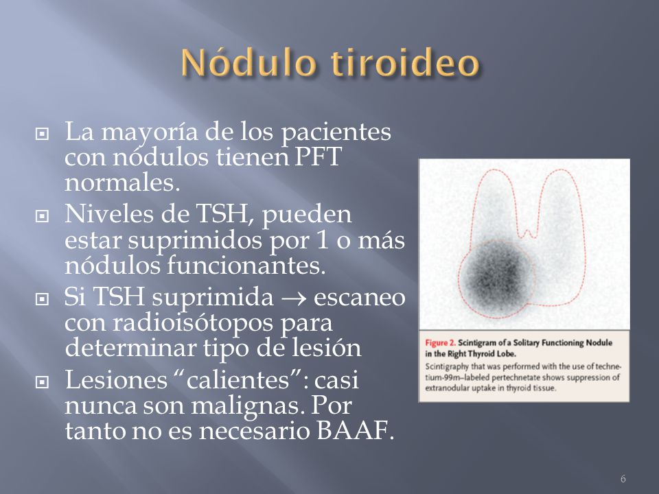 Nódulo tiroideo La mayoría de los pacientes con nódulos tienen PFT normales.