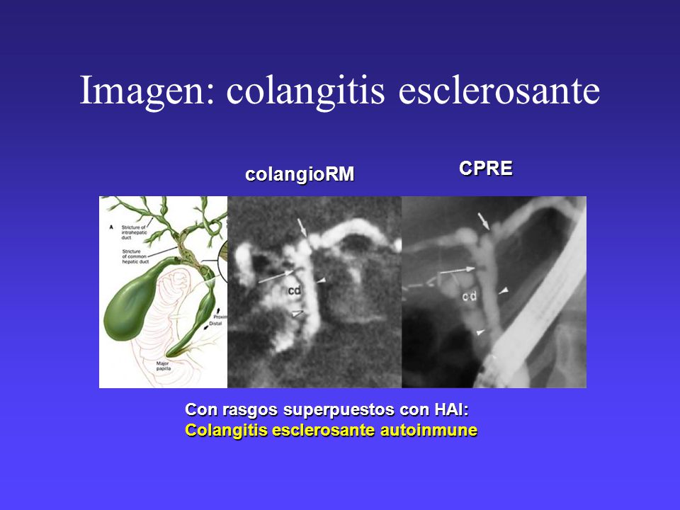 Imagen: colangitis esclerosante