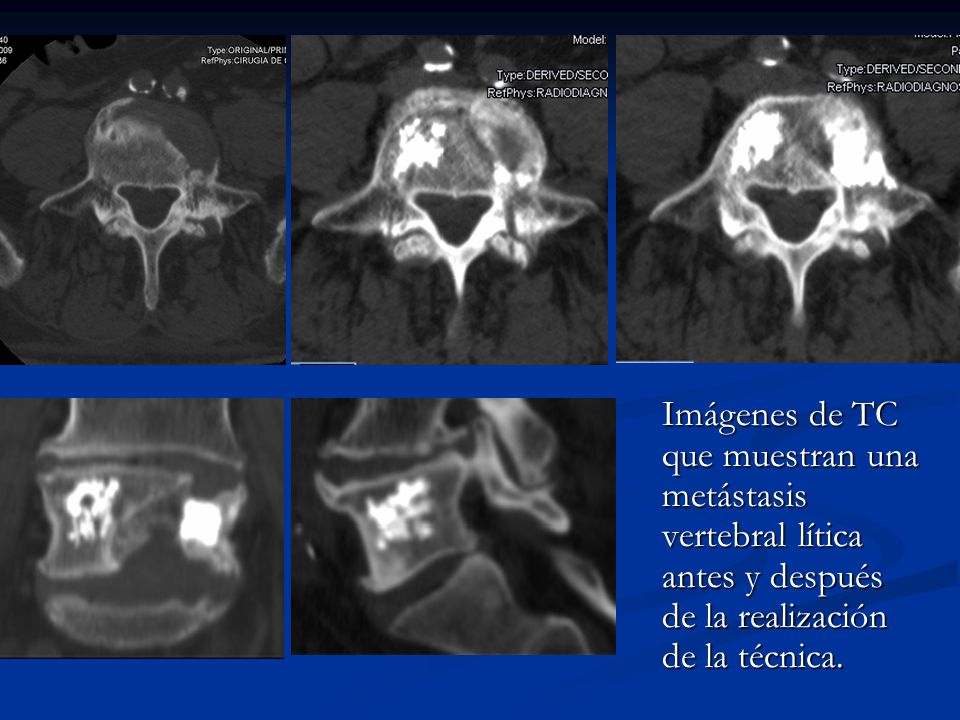 Imágenes de TC que muestran una metástasis vertebral lítica antes y después de la realización de la técnica.