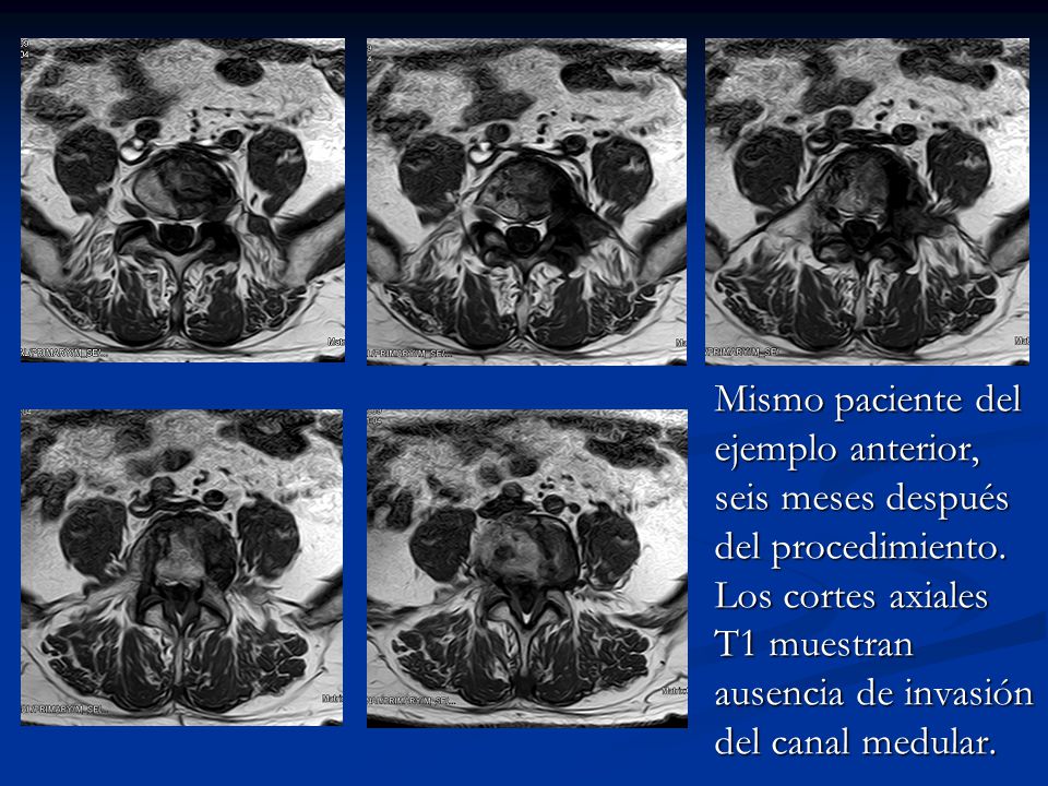 Mismo paciente del ejemplo anterior, seis meses después del procedimiento.