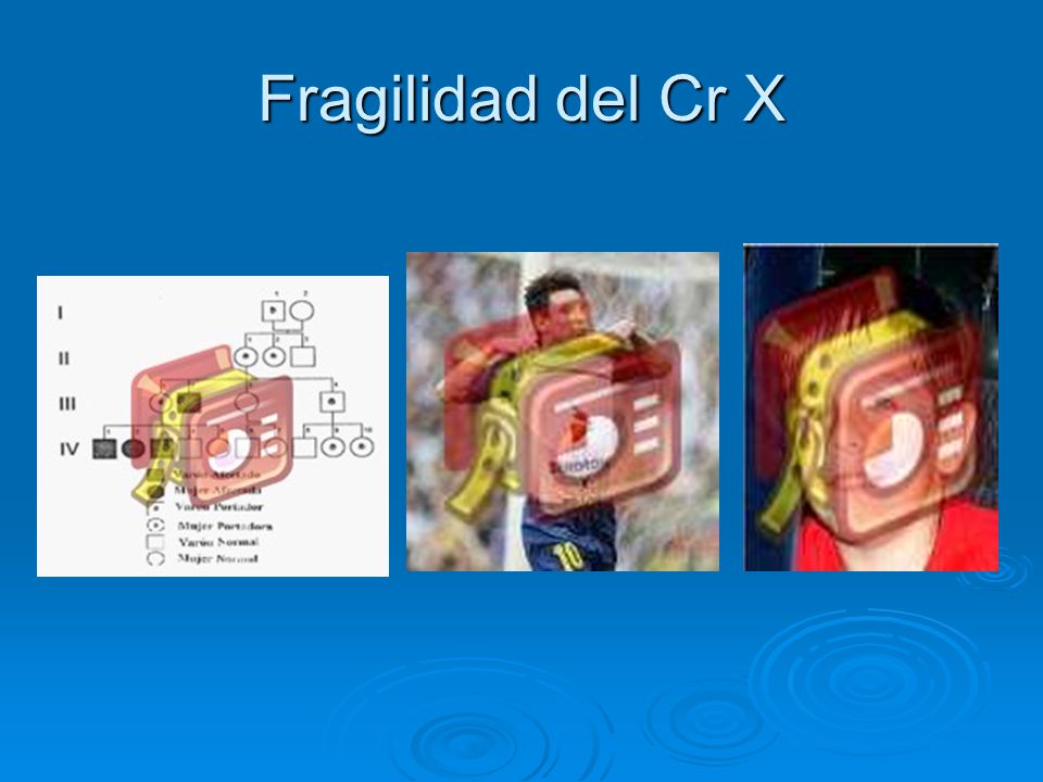 Fragilidad del Cr X Sindrome fraxa repeticion anormales de un tripleta de bases , los padecen mujeres y varones de distinta forma.