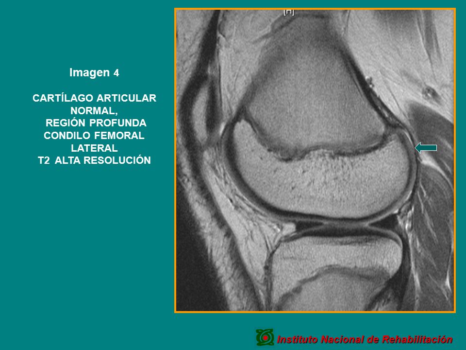 CARTÍLAGO ARTICULAR NORMAL, REGIÓN PROFUNDA CONDILO FEMORAL LATERAL