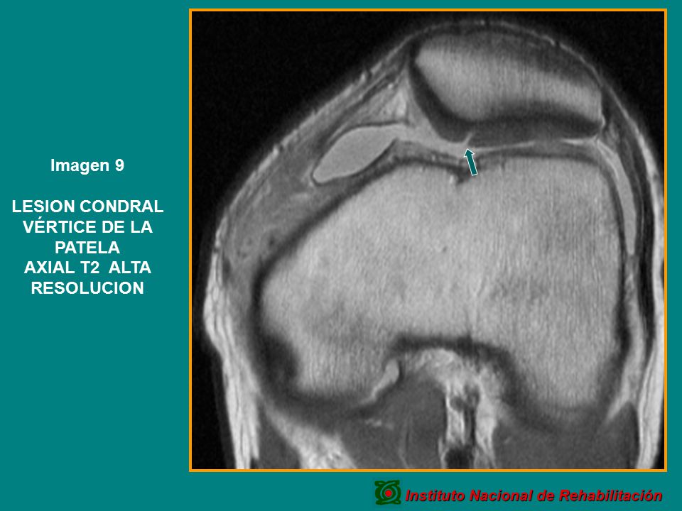 LESION CONDRAL VÉRTICE DE LA PATELA AXIAL T2 ALTA RESOLUCION