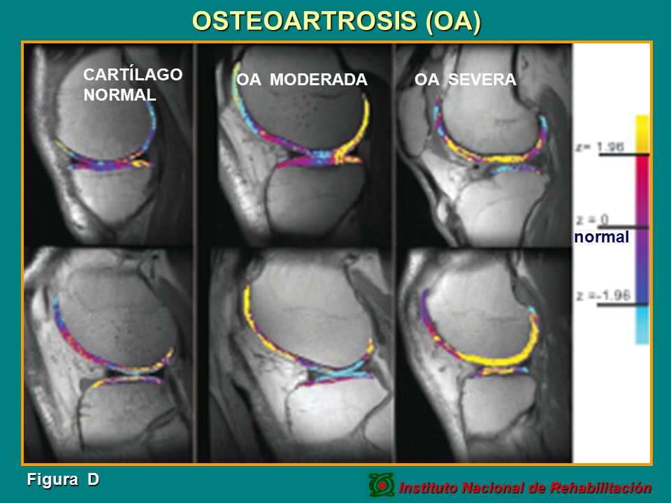 OSTEOARTROSIS (OA) CARTÍLAGO NORMAL OA MODERADA OA SEVERA normal