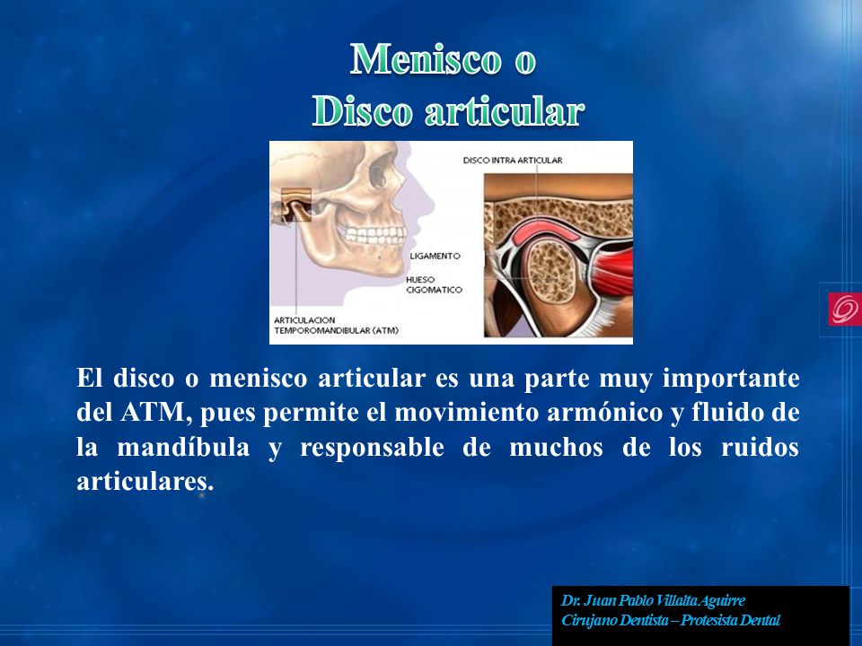Menisco o Disco articular