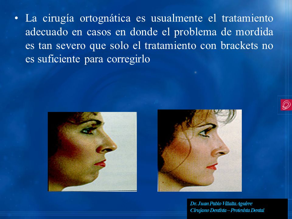 La cirugía ortognática es usualmente el tratamiento adecuado en casos en donde el problema de mordida es tan severo que solo el tratamiento con brackets no es suficiente para corregirlo