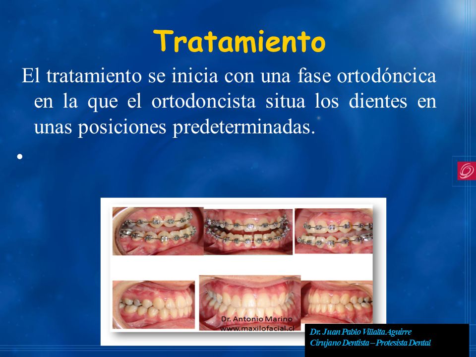 Tratamiento El tratamiento se inicia con una fase ortodóncica en la que el ortodoncista situa los dientes en unas posiciones predeterminadas.