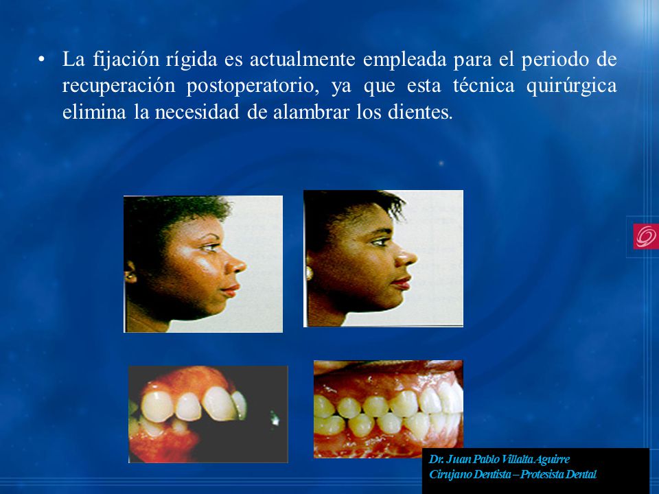 La fijación rígida es actualmente empleada para el periodo de recuperación postoperatorio, ya que esta técnica quirúrgica elimina la necesidad de alambrar los dientes.
