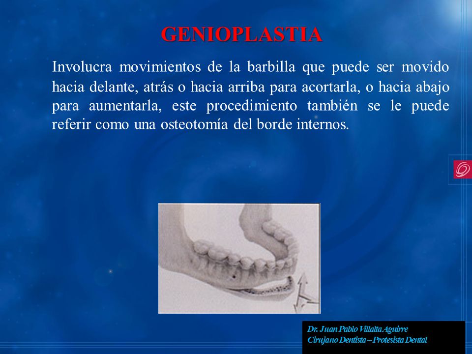 GENIOPLASTIA Involucra movimientos de la barbilla que puede ser movido hacia delante, atrás o hacia arriba para acortarla, o hacia abajo para aumentarla, este procedimiento también se le puede referir como una osteotomía del borde internos.
