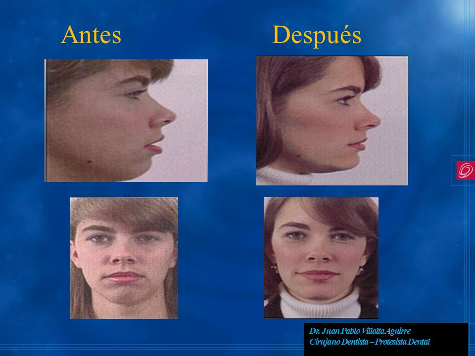 Antes Después Dr. Juan Pablo Villalta Aguirre Cirujano Dentista – Protesista Dental