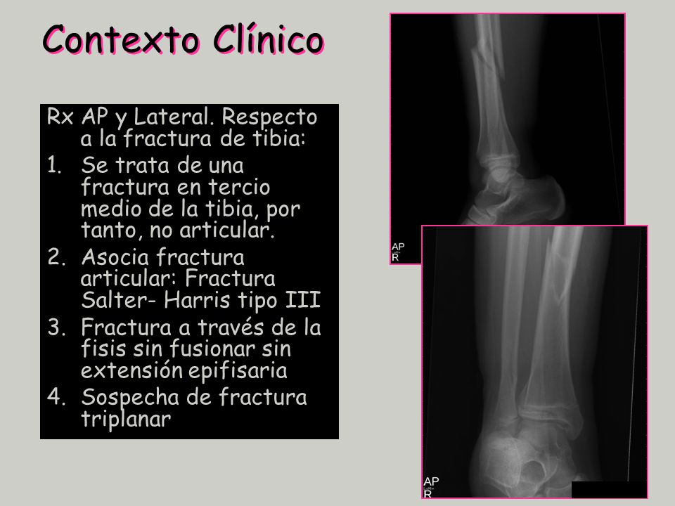 Contexto Clínico Rx AP y Lateral. Respecto a la fractura de tibia: