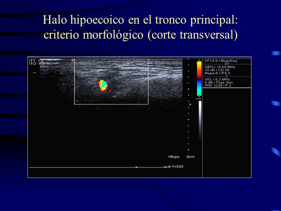 Halo hipoecoico en el tronco principal: criterio morfológico (corte transversal)