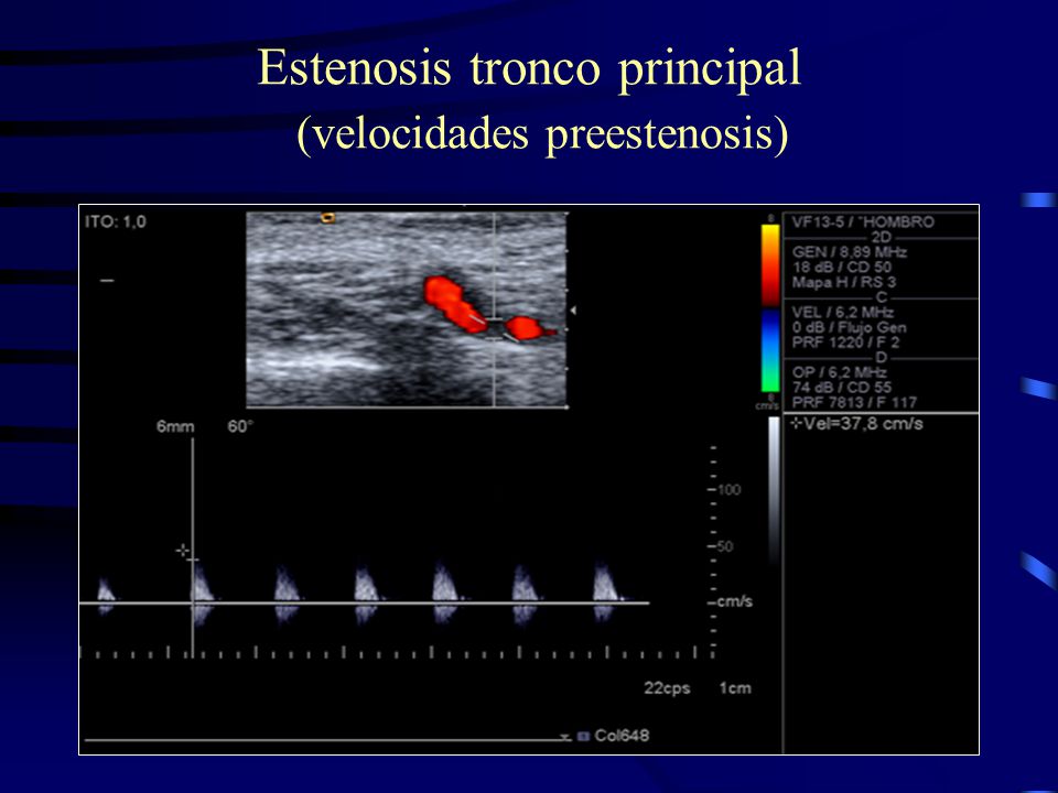 Estenosis tronco principal (velocidades preestenosis)