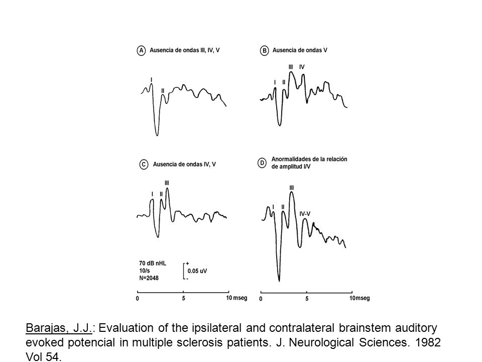 Barajas, J.J.: Evaluation of the ipsilateral and contralateral brainstem auditory evoked potencial in multiple sclerosis patients.