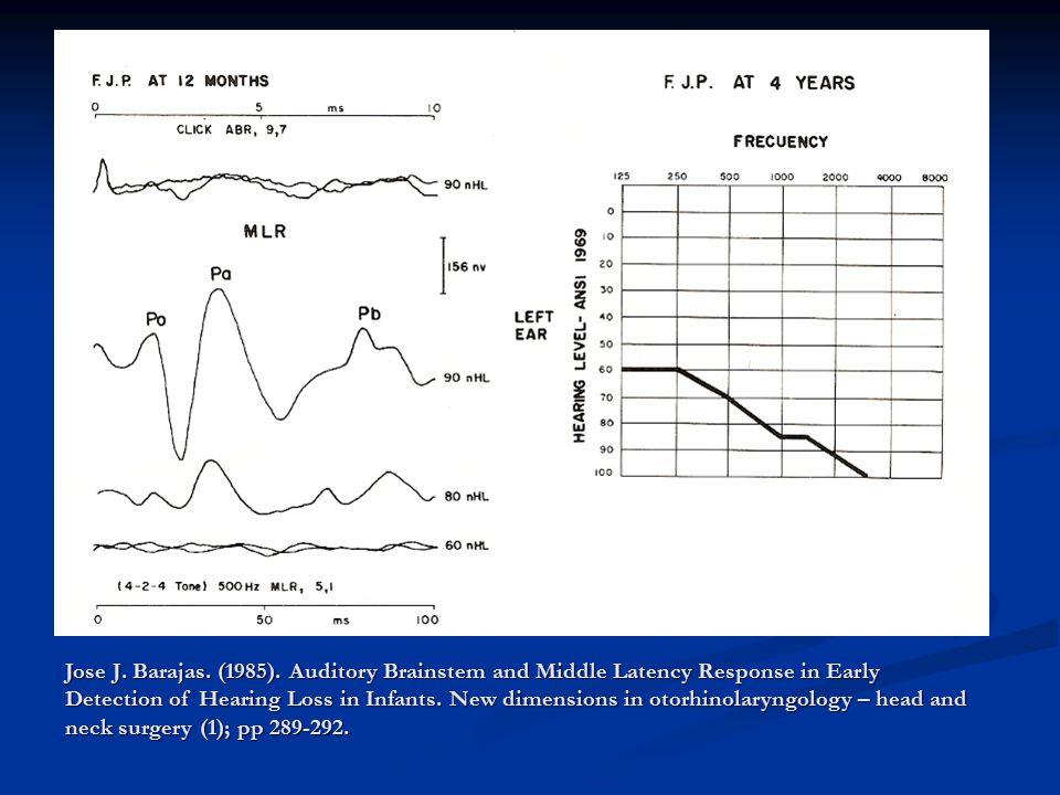 Audiogram configuration from AEP in the eighties