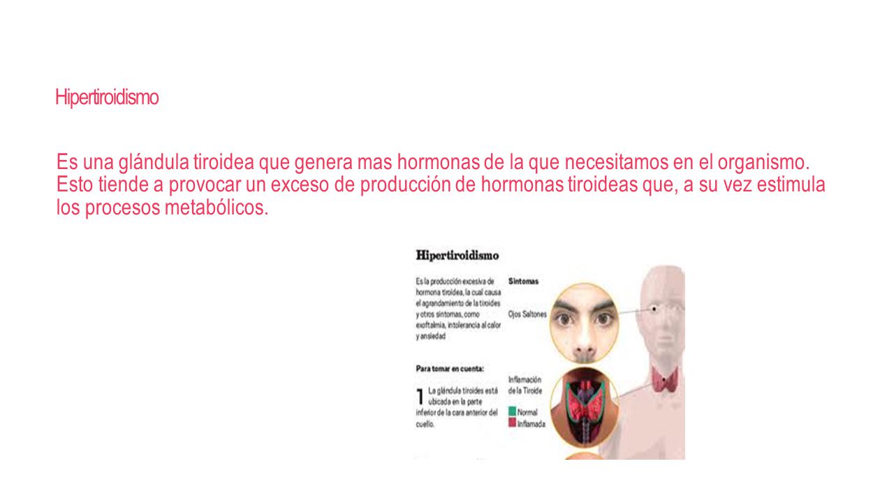 Hipertiroidismo
