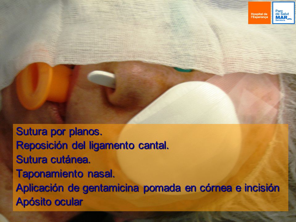 Sutura por planos. Reposición del ligamento cantal. Sutura cutánea. Taponamiento nasal. Aplicación de gentamicina pomada en córnea e incisión.