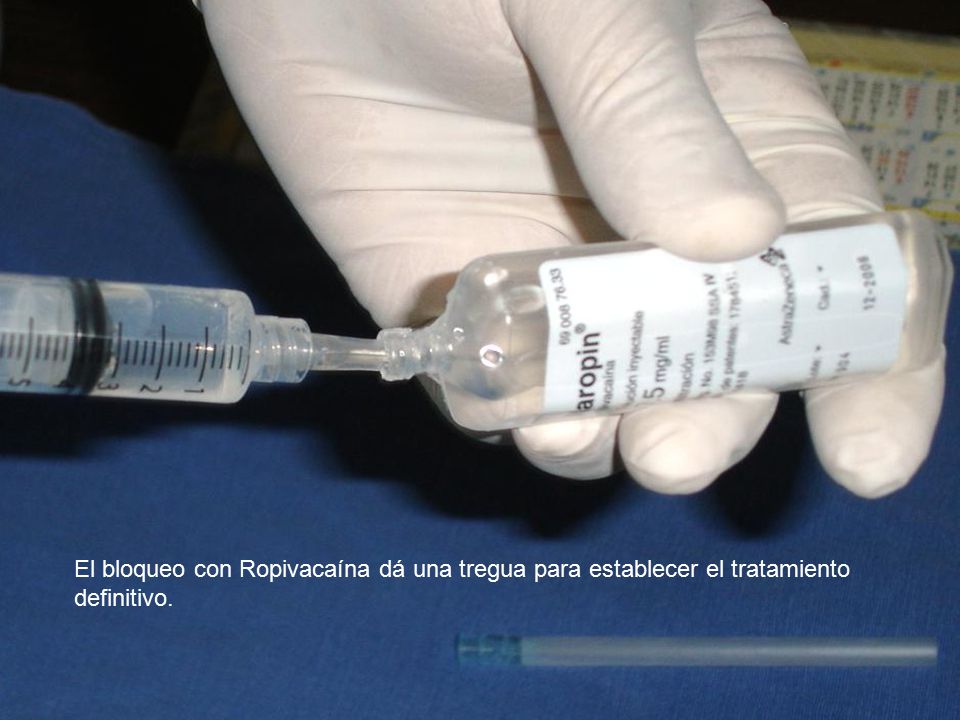 El bloqueo con Ropivacaína dá una tregua para establecer el tratamiento definitivo.
