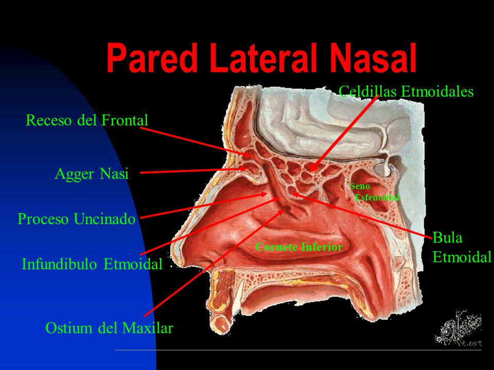 Pared Lateral Nasal Celdillas Etmoidales Receso del Frontal Agger Nasi
