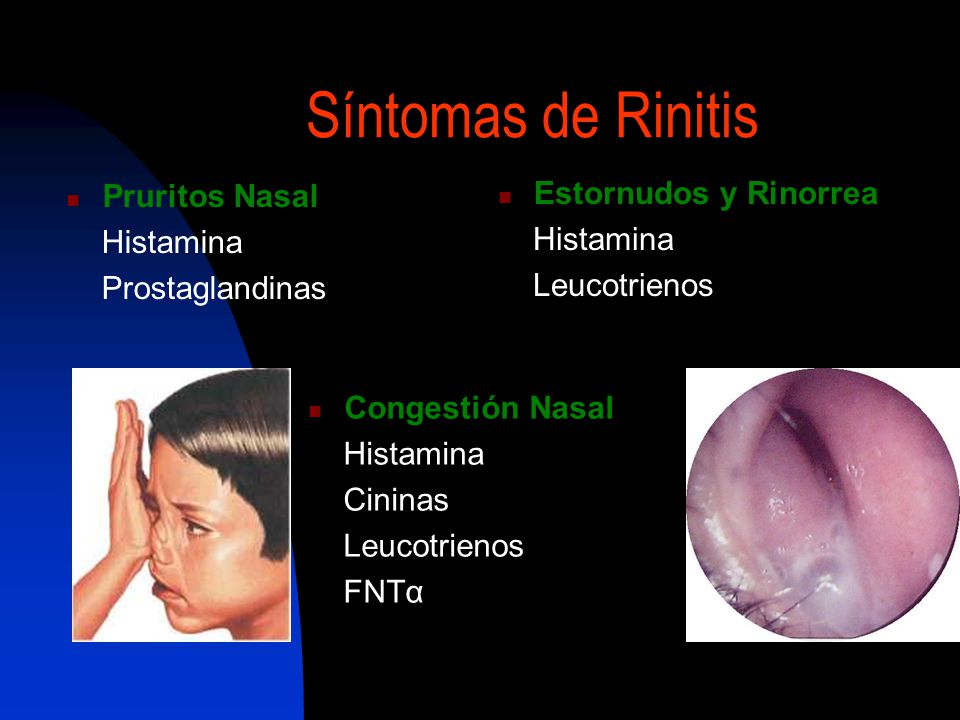 Síntomas de Rinitis Pruritos Nasal Estornudos y Rinorrea Histamina