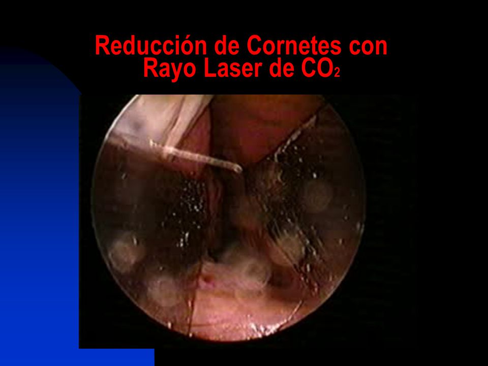 Reducción de Cornetes con Rayo Laser de CO2