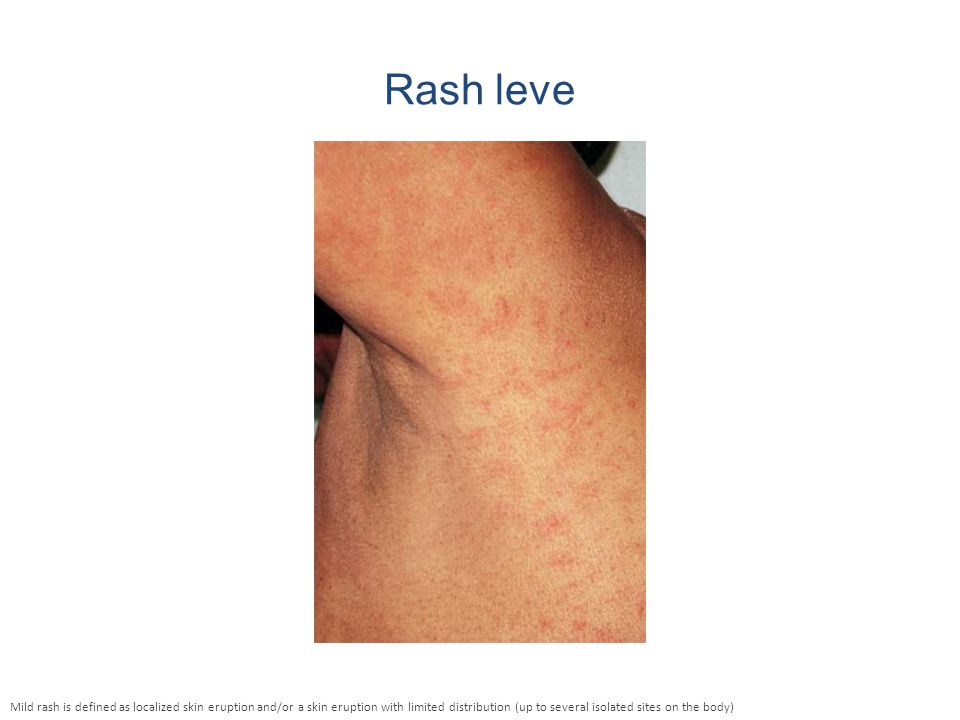 Rash leve Mild rash is defined as localized skin eruption and/or a skin eruption with limited distribution (up to several isolated sites on the body)
