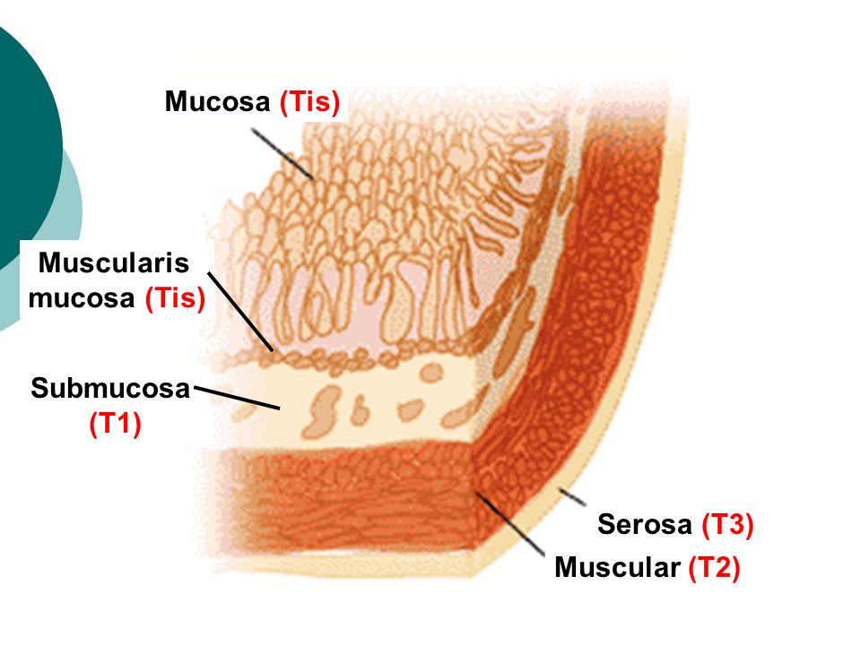 Mucosa (Tis) Muscularis mucosa (Tis) Submucosa (T1) Serosa (T3) Muscular (T2)