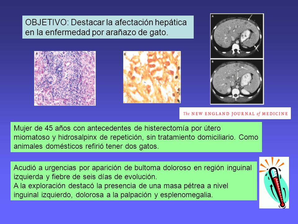 OBJETIVO: Destacar la afectación hepática en la enfermedad por arañazo de gato.