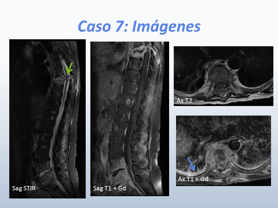 Caso 7: Imágenes Ax T2 Ax T1 + Gd Sag STIR Sag T1 + Gd