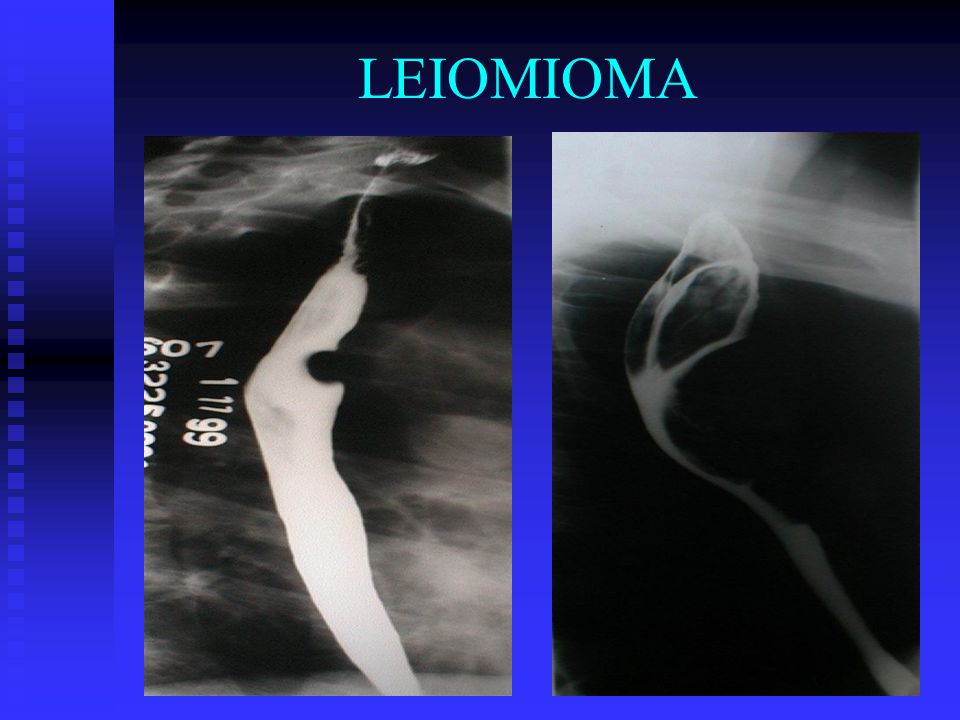 LEIOMIOMA