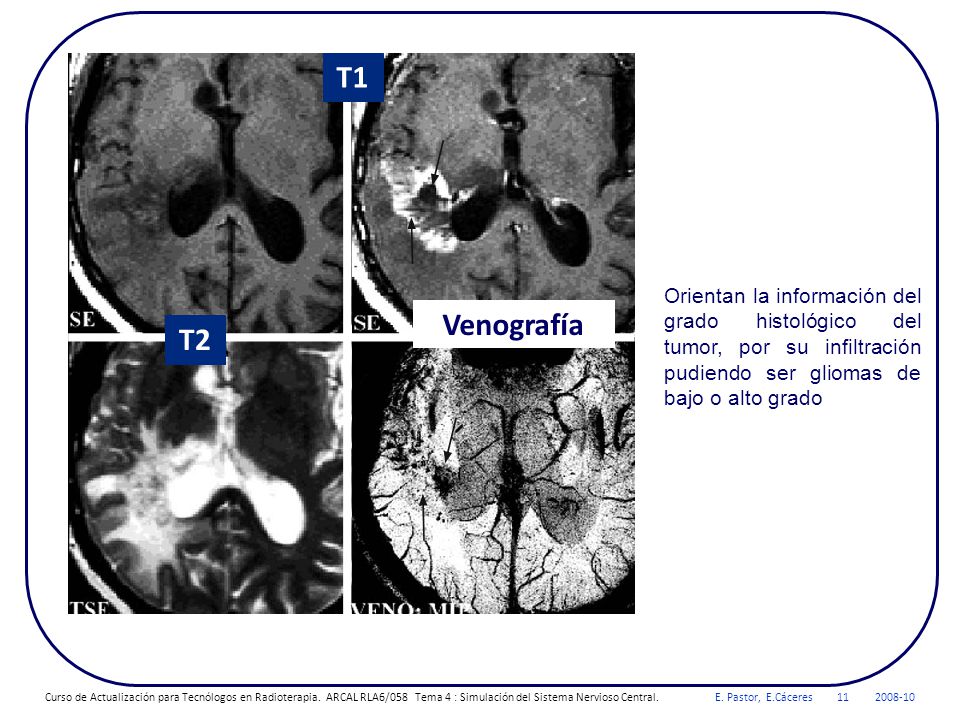 T1 Orientan la información del grado histológico del tumor, por su infiltración pudiendo ser gliomas de bajo o alto grado.