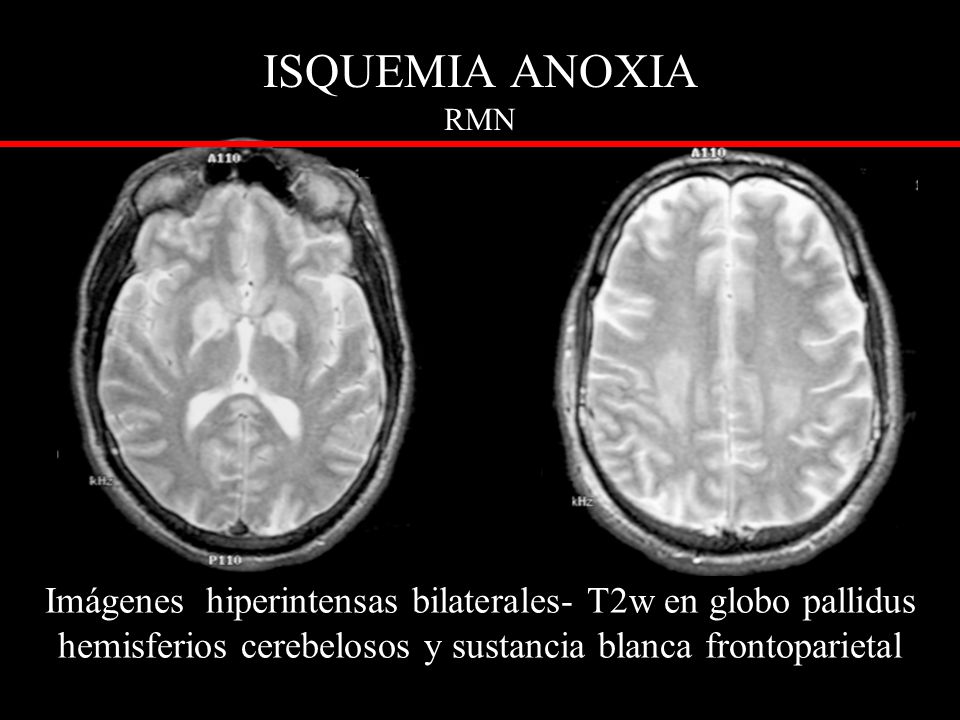 ISQUEMIA ANOXIA RMN Imágenes hiperintensas bilaterales- T2w en globo pallidus hemisferios cerebelosos y sustancia blanca frontoparietal.