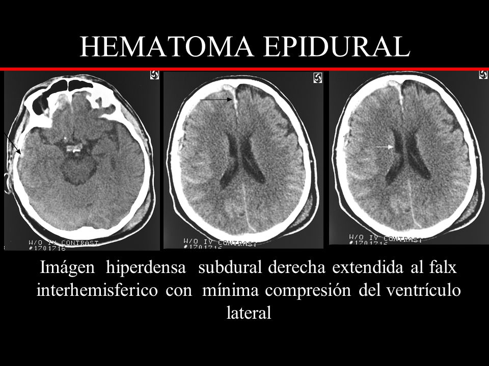 HEMATOMA EPIDURAL Imágen hiperdensa subdural derecha extendida al falx interhemisferico con mínima compresión del ventrículo lateral.