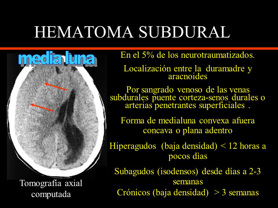 HEMATOMA SUBDURAL media luna En el 5% de los neurotraumatizados.