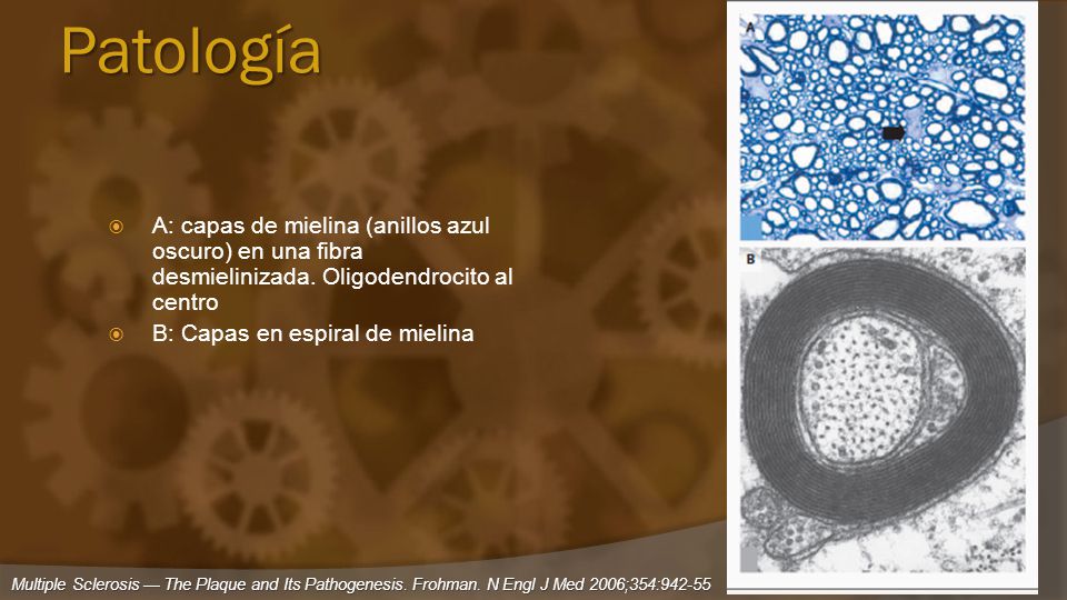 Patología A: capas de mielina (anillos azul oscuro) en una fibra desmielinizada. Oligodendrocito al centro.
