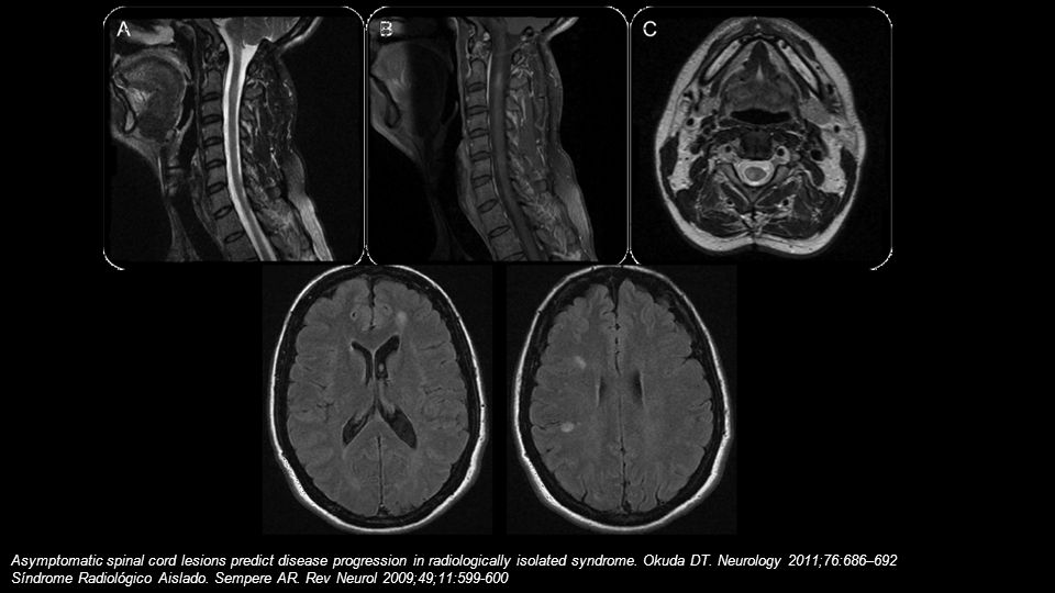 Asymptomatic spinal cord lesions predict disease progression in radiologically isolated syndrome. Okuda DT. Neurology 2011;76:686–692