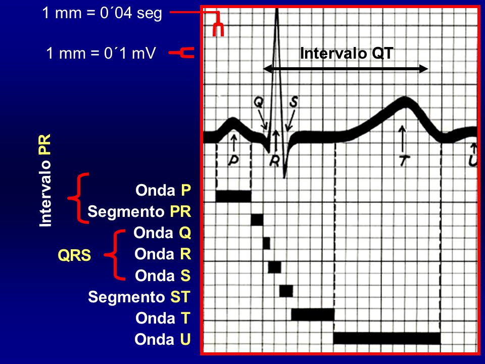 1 mm = 0´04 seg 1 mm = 0´1 mV Intervalo QT Intervalo PR Onda P
