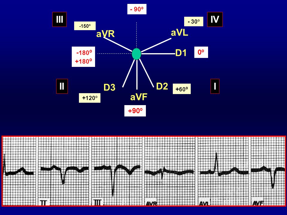 III IV aVR aVL D1 II D3 D2 I aVF -180º 0º +90º - 90º +180º +60º - 30º