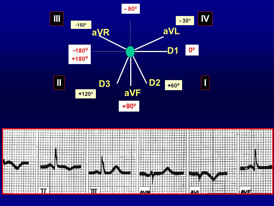 III IV aVR aVL D1 II D3 D2 I aVF -180º 0º +90º - 90º +180º +60º - 30º