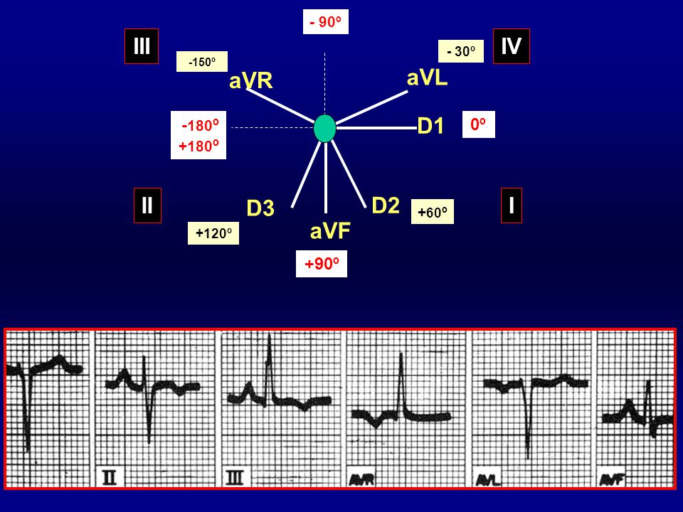 III IV aVR aVL D1 II D3 D2 I aVF -180º 0º +90º - 90º +180º +60º - 30º
