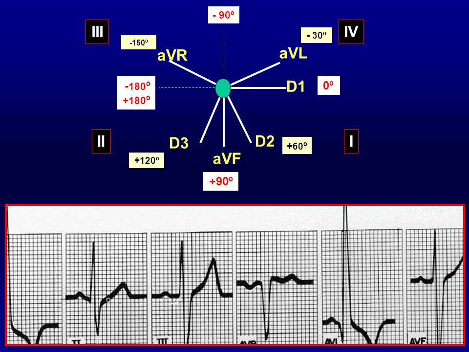 III IV aVR aVL D1 II D3 D2 I aVF -180º 0º +90º - 90º +180º +60º - 30º