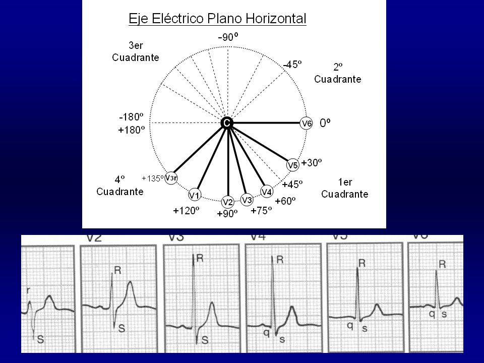 ÂQRS en el plano horizontal: alrededor de +15º
