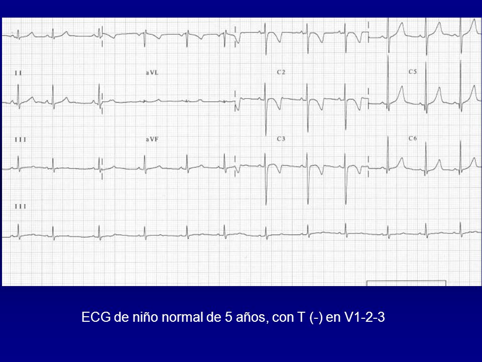 ECG de niño normal de 5 años, con T (-) en V1-2-3