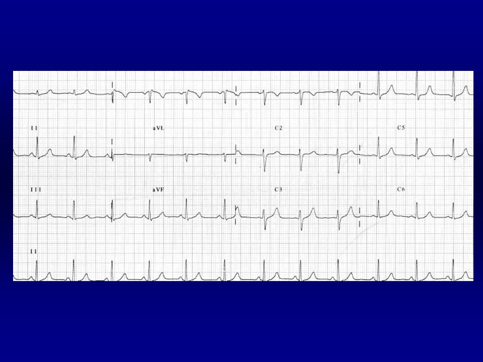 Frecuencia: 13 x 6 = 78 l.p.m. Ritmico. P: delante del QRS. Â: +60º. PR:0.13 s.
