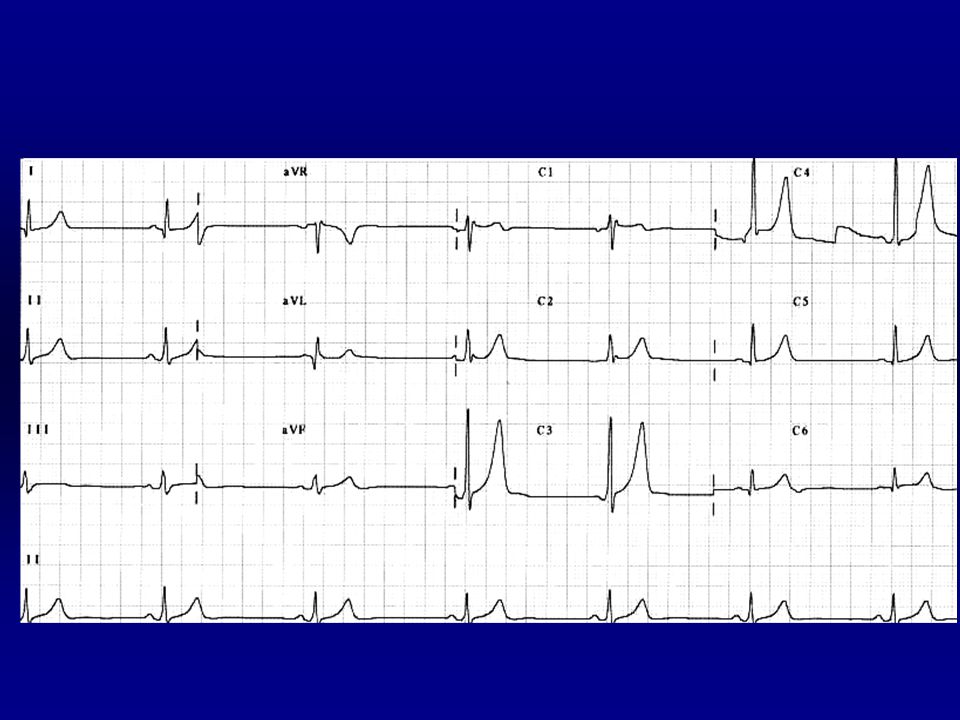 Frecuencia: 7 x 6 = 42 l.p.m. Ritmico. P: delante del QRS. Â: +60º. PR:0.11 s.