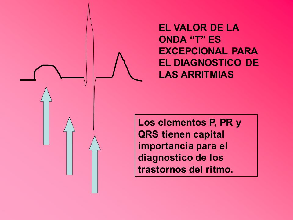 EL VALOR DE LA ONDA T ES EXCEPCIONAL PARA EL DIAGNOSTICO DE LAS ARRITMIAS