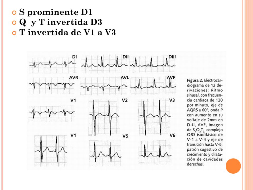S prominente D1 Q y T invertida D3 T invertida de V1 a V3