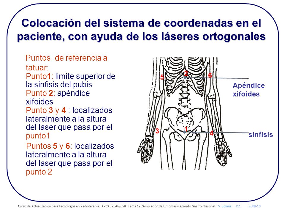 Colocación del sistema de coordenadas en el paciente, con ayuda de los láseres ortogonales